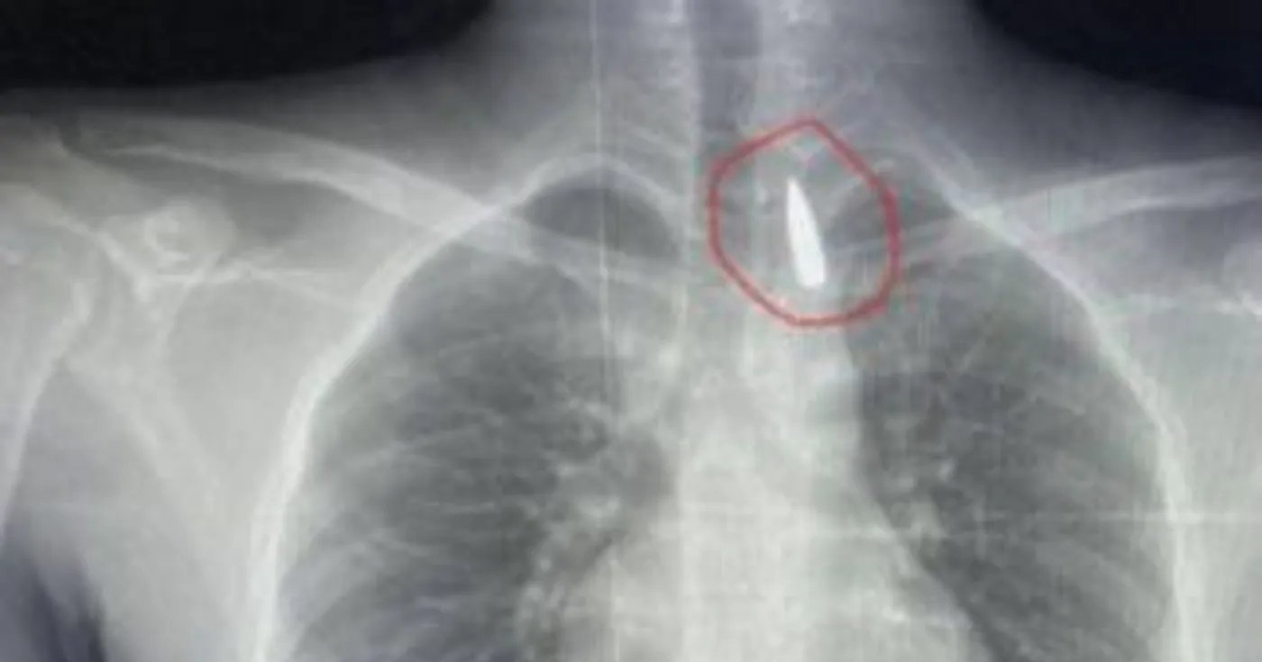 إنقاذ مصاب من غزة بعد استخراج مقذوف استقر في صدره