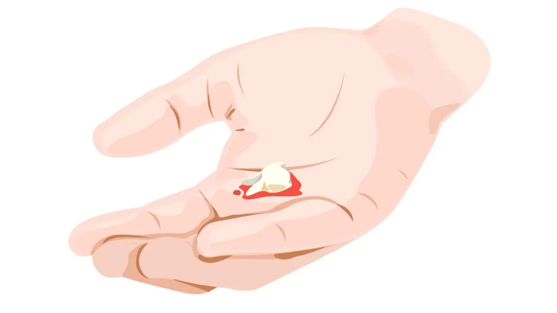 فقدان الأسنان قد يكون نذير شؤم ..  ما دلالته