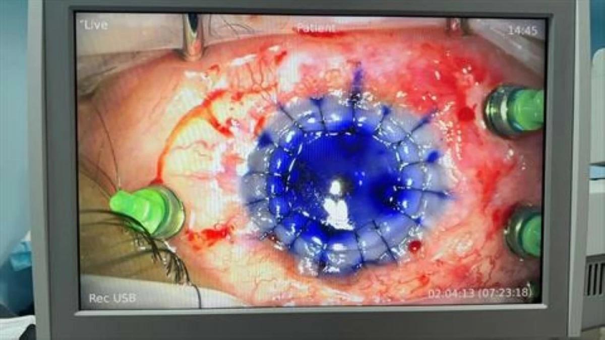 عمليّة نوعية مركّبة في قسم العيون في مستشفى الملك المؤسّس