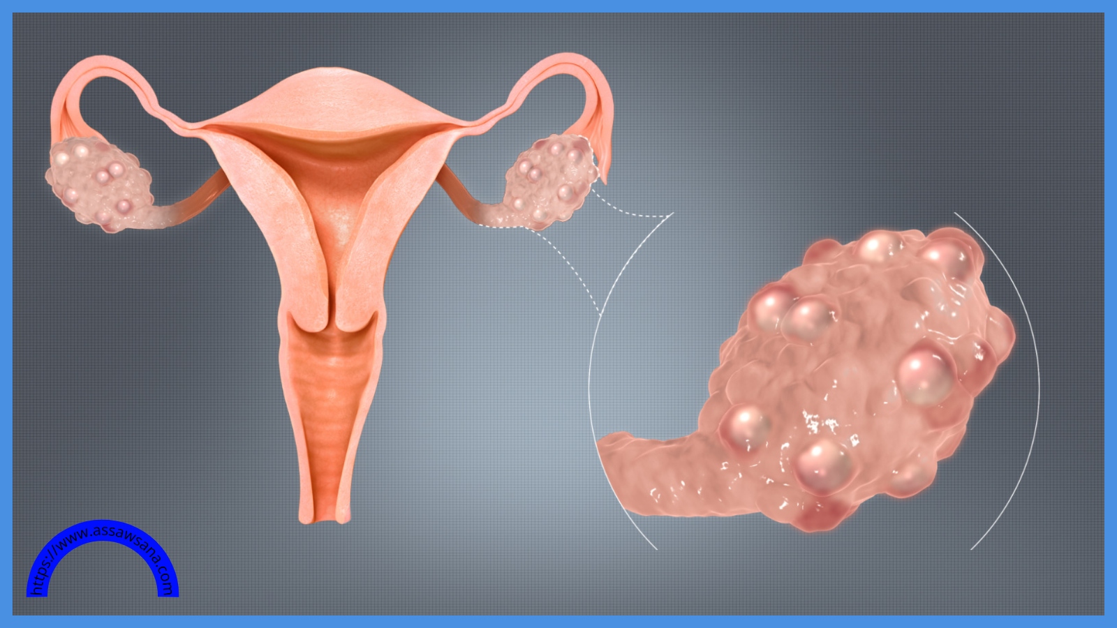 متلازمة تكيّس المبايض