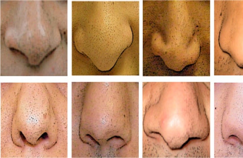 خبير تجميل: لا يوجد أنف مثالي  ..  التناسق مع ملامح الوجه هو الأساس