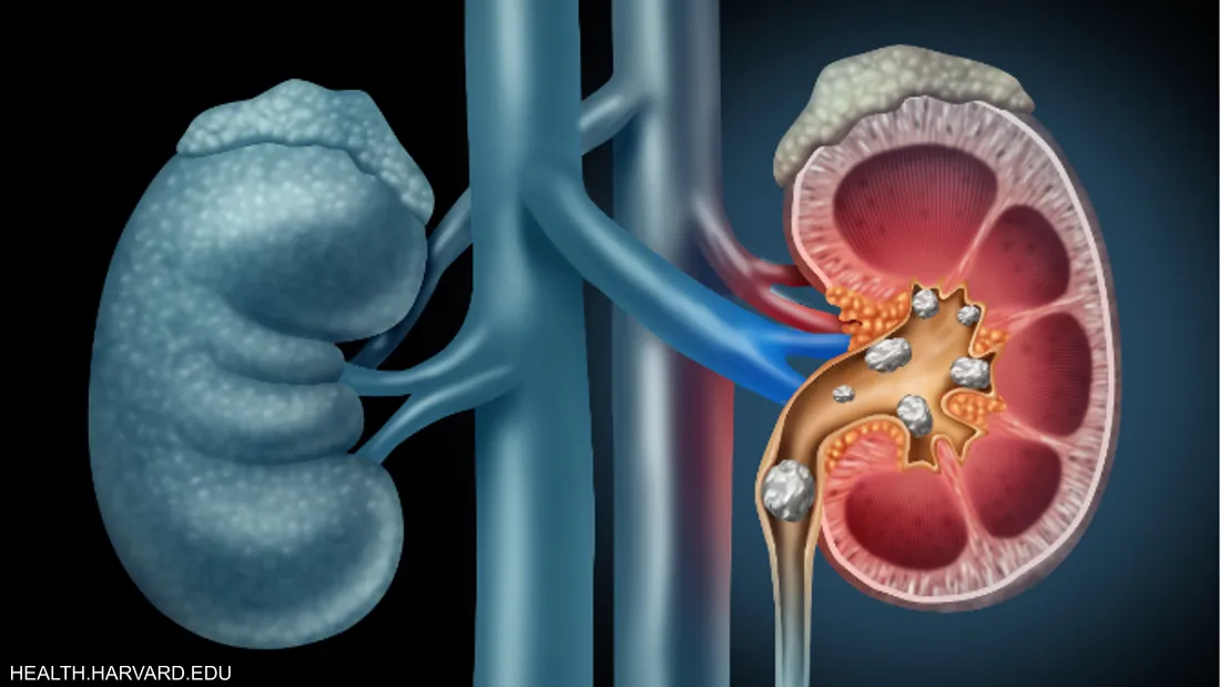 أداة ذكاء اصطناعي جديدة من إستونيا تكشف سرطان الكلى 