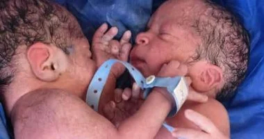 حالة نادرة لتوأم ملتصق في مصر
