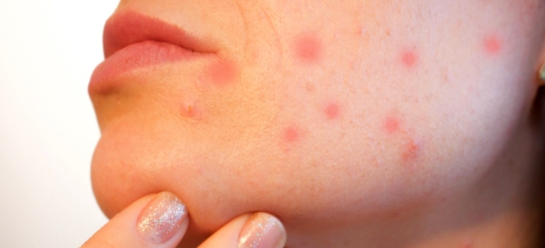 أسباب ظهور بقع حمراء على الجلد مع حكة