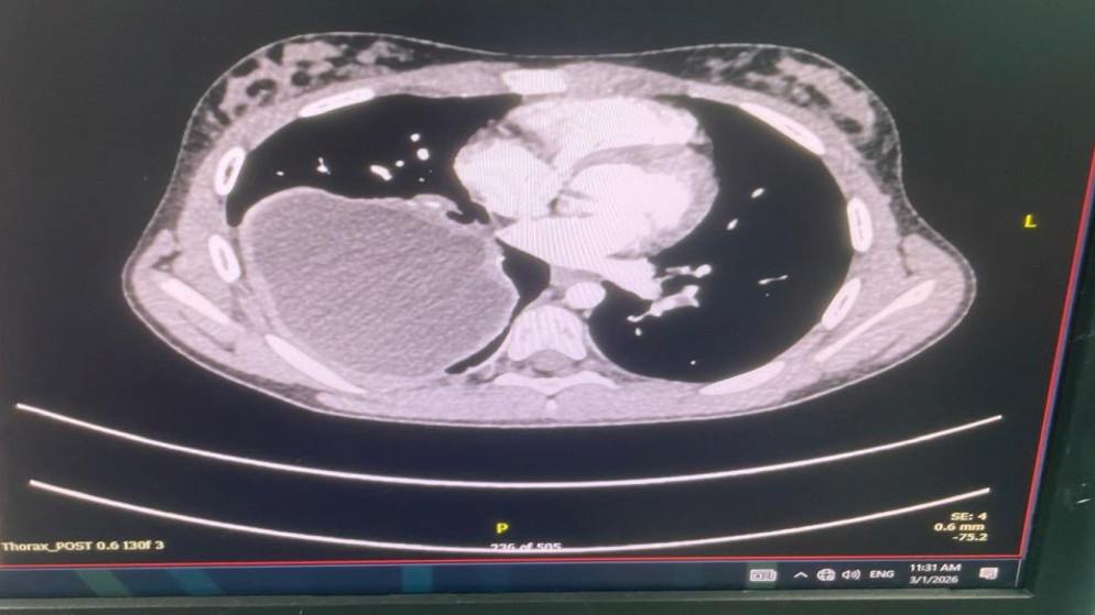 إجراء عملية نوعية في مركز الملكة علياء لأمراض وجراحة القلب