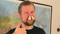 دنماركي يدخل 68 عود ثقاب في أنفه