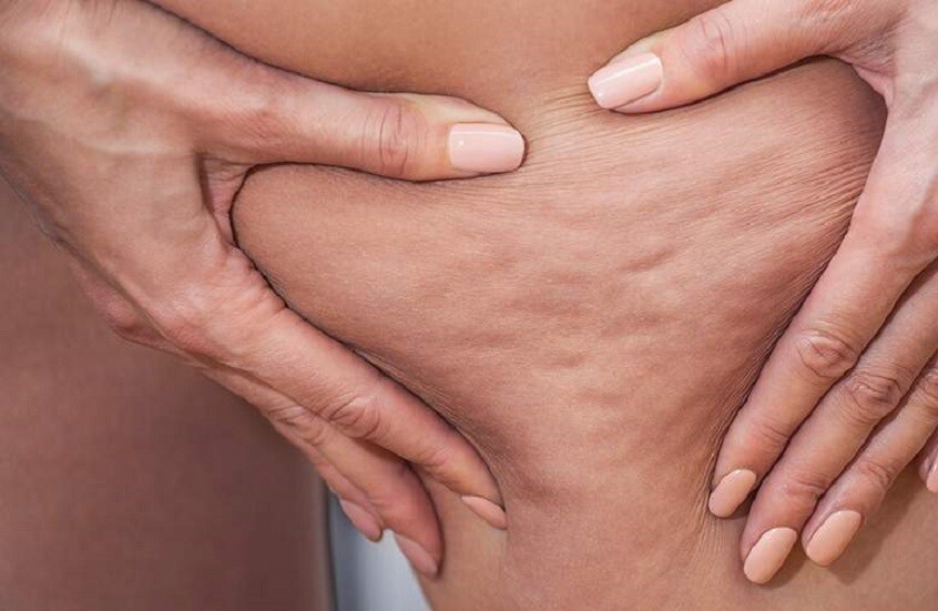 تجنّب أطعمة تحفّز السيلوليت واستبدالها بخيارات صحية