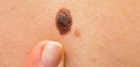 كيف تتجنب أحد أخطر أنواع سرطان الجلد