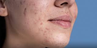 أخطاء شائعة للعناية في البشرة الدهنية 