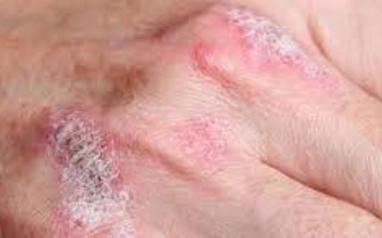 ارتفاع نسبة الإصابة بمرض بهجت في الأردن مقارنة بالنسب العالمية