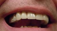 باحثون : سارع بعلاج أي خراج بالأسنان