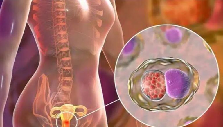 دواء تجريبي يضاعف فرص نجاة مريضات سرطان المبيض 