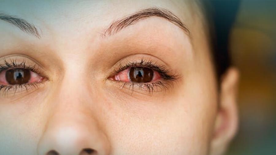 الوقاية من حساسية الربيع 