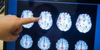 إصابة بـ"مرض فتاك" يدمر دماغ البشر في دولة آسيوية 