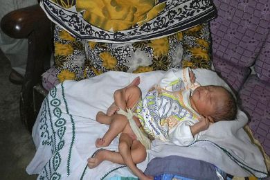 الطفل ذو الأرجل الـ6 يتخلى عن لقبه بعملية جراحية 
