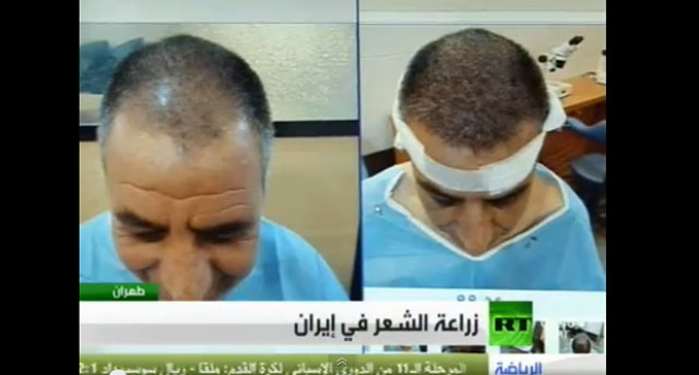 فيديو  .. عمليات زراعة الشعر في إيران