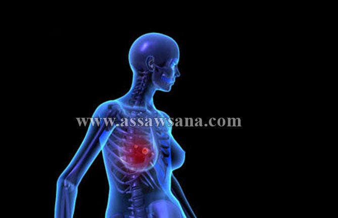 الاردن : اصابة بسرطان الثدي كل 8 ساعات