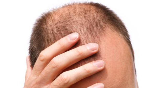  تجارب يمكن أن تقضي على الصلع نهائياً