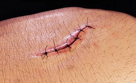 التئام الجروح المزمنة فى فترة قصيرة !