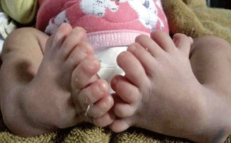 طفلة .. لديها ثمانية أصابع في كل قدم 