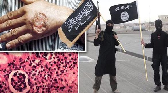 إصابة آلاف الدواعش بمرض طفيلي يؤدي لتآكل لحومهم