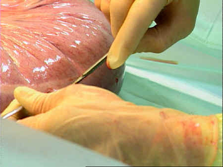 جمعية الجهاز الهضمي تحذر من عمليات غسيل القولون  