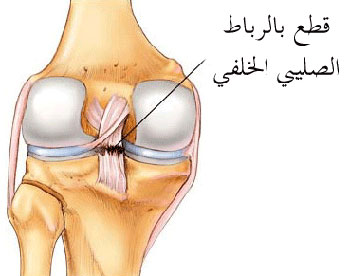 الجراحة ليست ضرورية لتمزق الرباط الصليبي للركبة