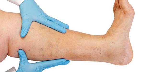 تجلط الدم بالساقين  ..  إليك الأعراض وأسباب الحدوث